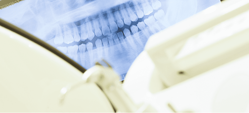 前歯インプラント治療の期間とプランニング