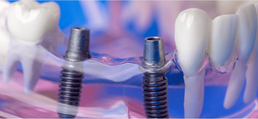前歯インプラントに対する患者の後悔