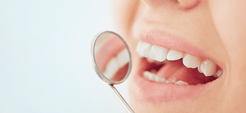 複数の前歯インプラントに関する費用